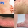 Nổi mẩn ngứa khắp người là bệnh gì? Nguyên nhân và cách xử lý hiệu quả