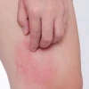 Nổi mẩn ngứa thành mảng khắp người: Nguyên nhân, dấu hiệu và cách xử lý hiệu quả
