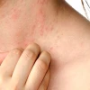 Nổi Mề Đay Mẩn Ngứa: Nguyên Nhân, Triệu Chứng và Cách Điều Trị Hiệu Quả