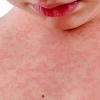 Nổi mụn đỏ ngứa khắp người: Nguyên nhân, cách điều trị và phòng ngừa hiệu quả