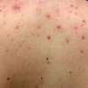Nổi mụn đỏ ở người: Nguyên nhân, dấu hiệu và cách điều trị hiệu quả