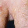 Nổi mụn nước khắp người không ngứa: Nguyên nhân và cách xử lý