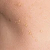 Nổi mụn thịt khắp người: Nguyên nhân, triệu chứng và cách điều trị hiệu quả