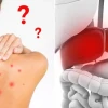 Nóng Gan Nổi Mụn Khắp Người: Nguyên Nhân, Cách Nhận Biết và Giải Pháp Hiệu Quả
