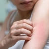 Nóng trong người nổi mụn nhọt nên uống gì để thanh nhiệt giải độc?