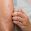 Nóng trong người nổi mụn nước: Nguyên nhân và cách xử lý hiệu quả
