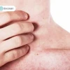 Rôm sảy ở người lớn: Nguyên nhân, triệu chứng và cách điều trị hiệu quả