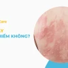 Sốt Nổi Mề Đay Ở Người Lớn: Nguyên Nhân, Triệu Chứng Và Cách Xử Lý