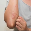 Sốt phát ban ở người lớn có ngứa không và cách xử lý hiệu quả