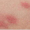 Thuốc Trị Hăm Mông Người Lớn: Nguyên Nhân, Cách Phòng Ngừa và Lựa Chọn Hiệu Quả