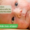 Thuốc trị rôm sảy ở người lớn: Nguyên nhân, dấu hiệu và cách xử lý hiệu quả