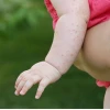 Trẻ bị nổi mẩn đỏ khắp người và sốt: Nguyên nhân, dấu hiệu và cách xử lý