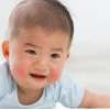 Trẻ bị nổi mụn nước khắp người: Nguyên nhân và cách xử lý hiệu quả