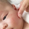 Trẻ Sơ Sinh Bị Nổi Mẩn Đỏ Khắp Người: Nguyên Nhân và Cách Xử Lý