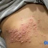 Triệu chứng nổi mụn nước ngứa khắp người: Nguyên nhân và cách xử lý hiệu quả