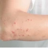 Trời Nóng Bị Ngứa Khắp Người: Nguyên Nhân Và Cách Xử Lý Hiệu Quả