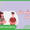 Tự nhiên bị nổi mẩn ngứa khắp người: Nguyên nhân và cách xử lý hiệu quả