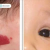 U Máu Dưới Da Ở Người Lớn: Nguyên Nhân, Triệu Chứng và Cách Xử Trí Đúng Đắn