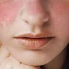 Viêm da cơ địa ở người lớn: Nguyên nhân, dấu hiệu và cách điều trị hiệu quả