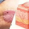 Bệnh Vẩy Nến Rối Loạn Tự Miễn Ở Da Nguyên Nhân Triệu Chứng Và Cách Điều Trị