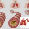 Cơ chế miễn dịch trong bệnh hen suyễn Hiểu rõ và kiểm soát