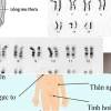 Hội chứng Turner và Klinefelter Rối loạn Nhiễm sắc thể Giới tính