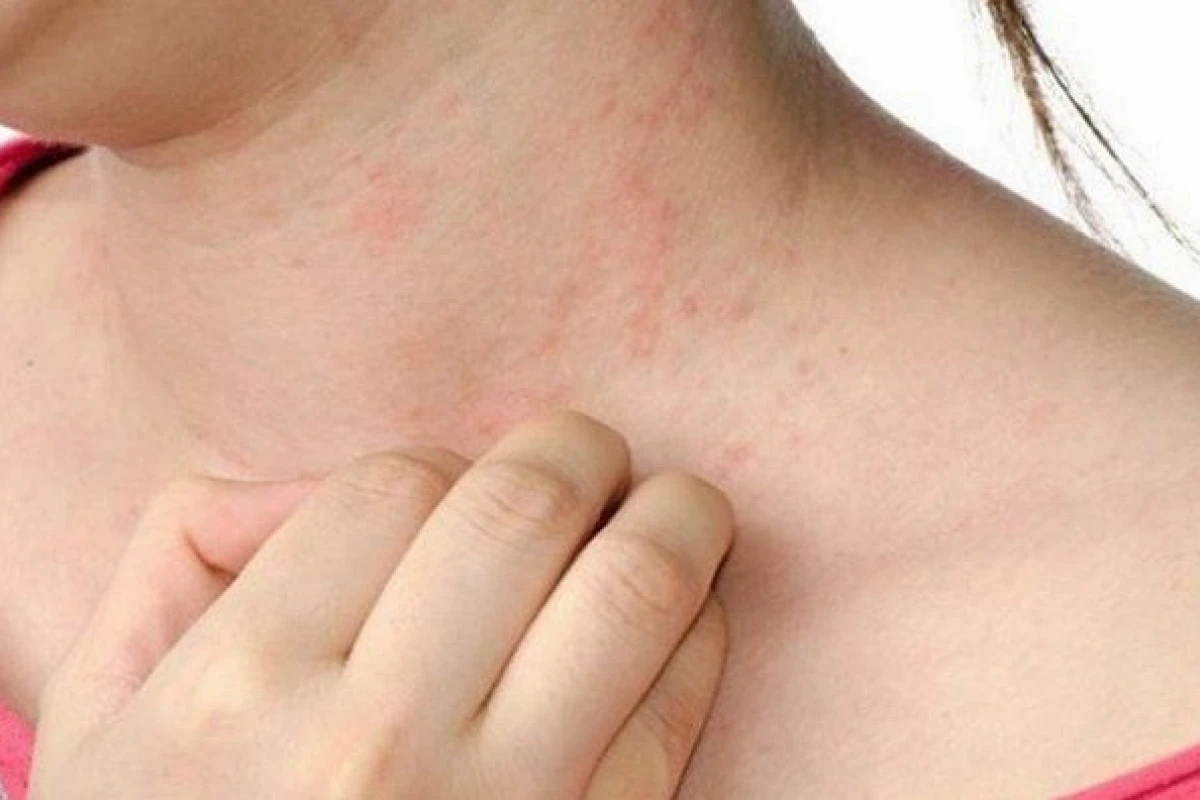Bị nổi mẩn đỏ khắp người và ngứa: Nguyên nhân, cách xử lý và phòng ngừa