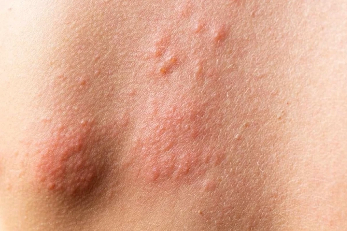 Biểu hiện HIV ngoài da: Nhận biết sớm các dấu hiệu bất thường