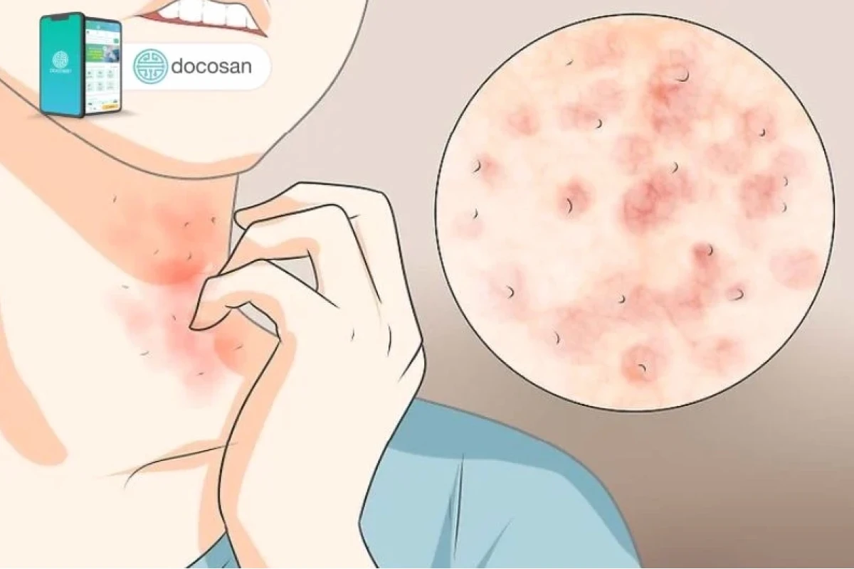 Ghẻ phỏng ở người lớn: Nguyên nhân, triệu chứng và cách điều trị hiệu quả