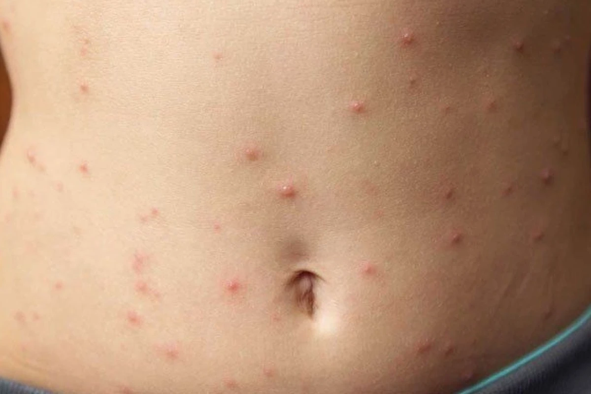 Người mọc mụn nước ngứa: Nguyên nhân và cách xử lý hiệu quả