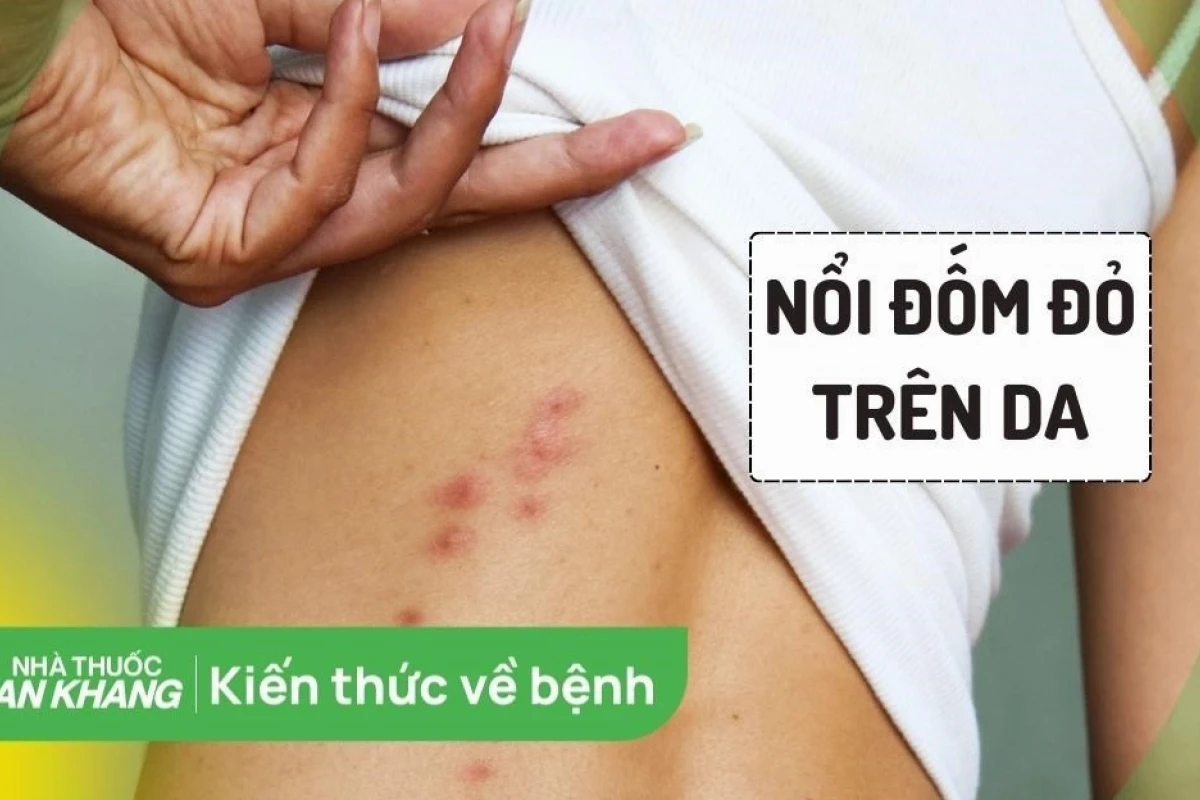 Nổi đốm đỏ trên da: Nguyên nhân, triệu chứng và cách xử lý hiệu quả