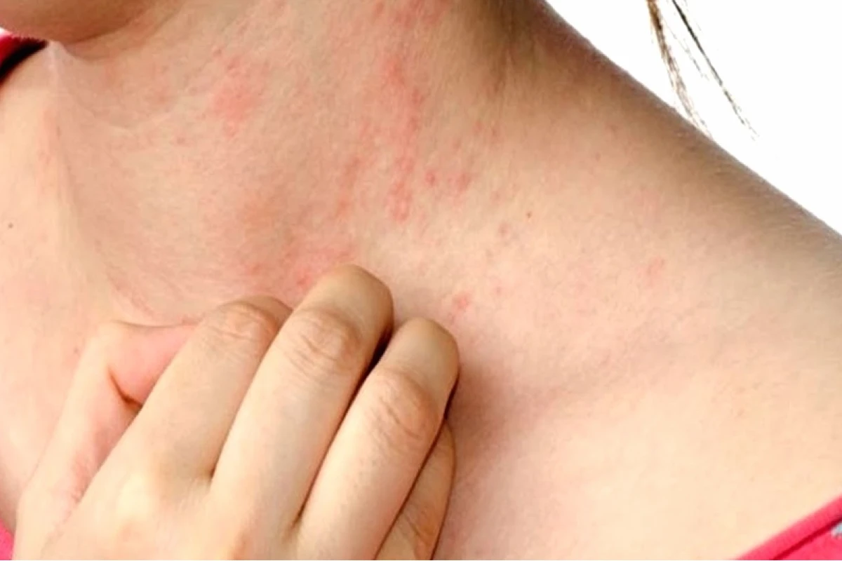 Nổi Mề Đay Mẩn Ngứa: Nguyên Nhân, Triệu Chứng và Cách Điều Trị Hiệu Quả