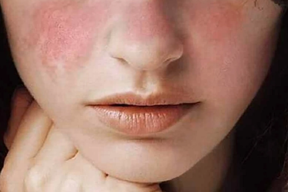 Viêm da cơ địa ở người lớn: Nguyên nhân, dấu hiệu và cách điều trị hiệu quả