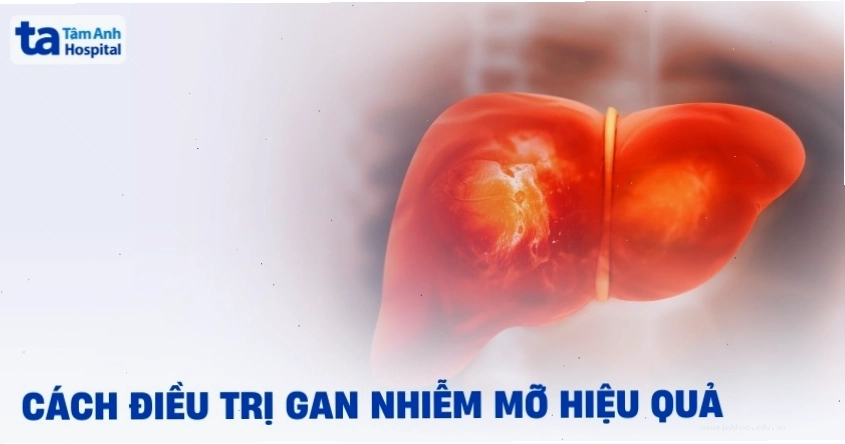 10 cách điều trị gan nhiễm mỡ không dùng thuốc tại nhà