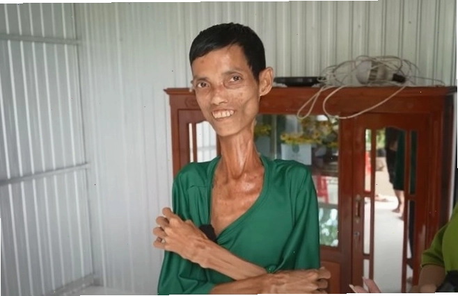 Anh H. sở hữu thân hình gầy gò, chỉ còn da bọc xương là hình ảnh minh chứng cho tình trạng gầy nhất Việt Nam