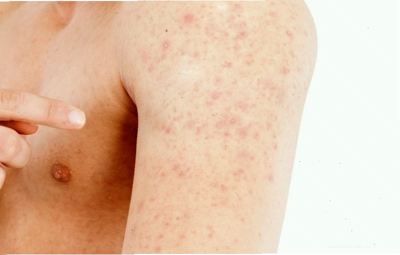 Bác sĩ kiểm tra tình trạng rôm sảy trên da người lớn