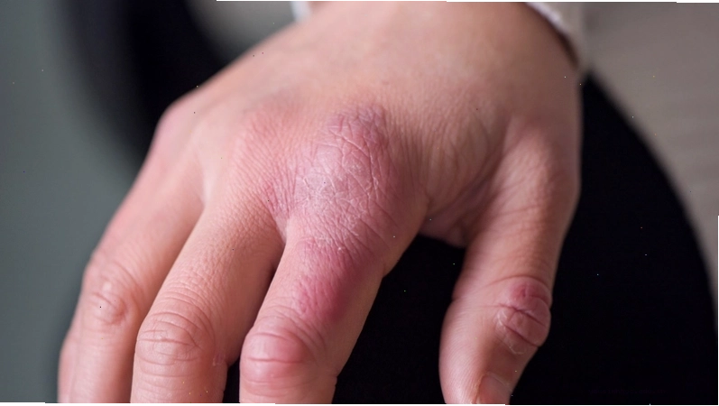Bác sĩ thăm khám và tư vấn cho bệnh nhân viêm da cơ địa