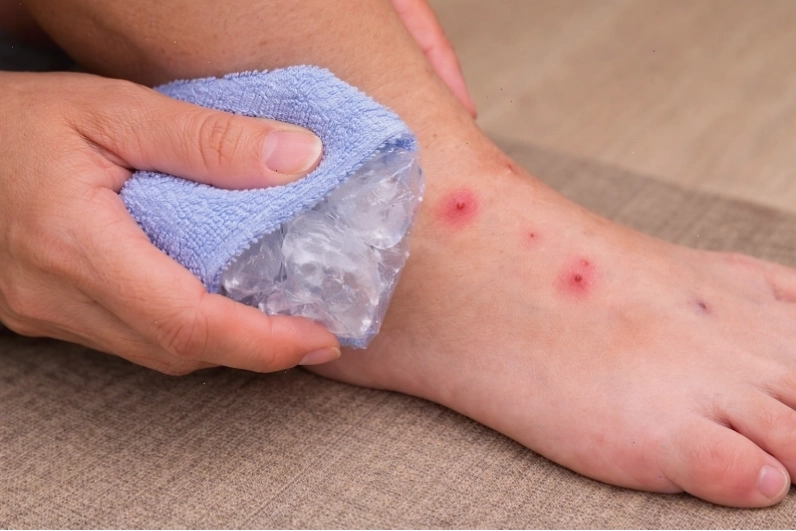 Bạn có thể chườm lạnh trong khoảng 10 - 15 phút để làm dịu cảm giác ngứa và hạn chế sưng