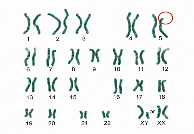 Bất thường nhiễm sắc thể là nguyên nhân chính gây ra hội chứng tiếng mèo kêu ở trẻ