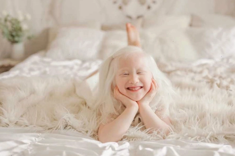 Bệnh bạch tạng không lây nhiễm qua tiếp xúc
