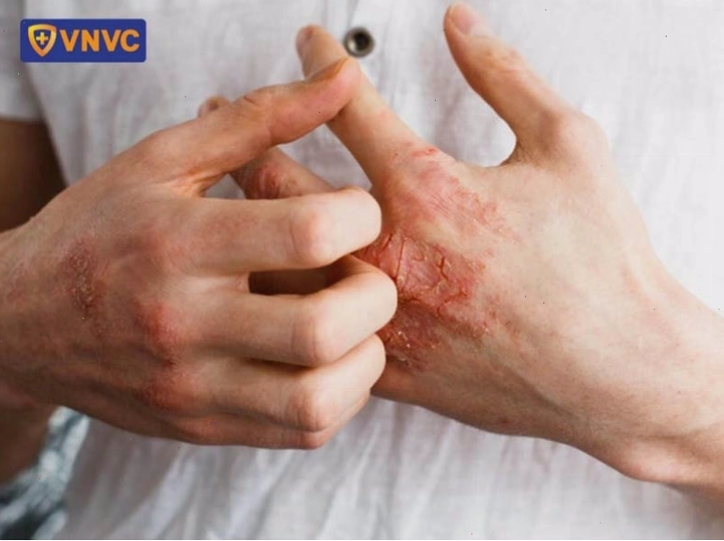 Bệnh chàm gây khô da, ngứa và có vảy là một dấu hiệu của hệ miễn dịch quá mạnh