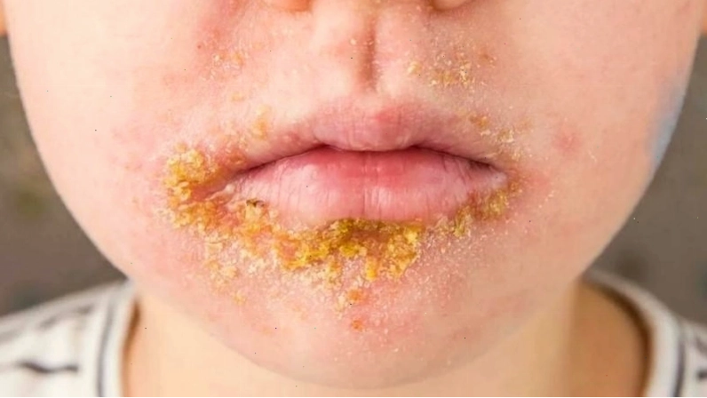 Bệnh chốc là tình trạng nhiễm trùng ở lớp nông của thượng bì do vi khuẩn gây ra