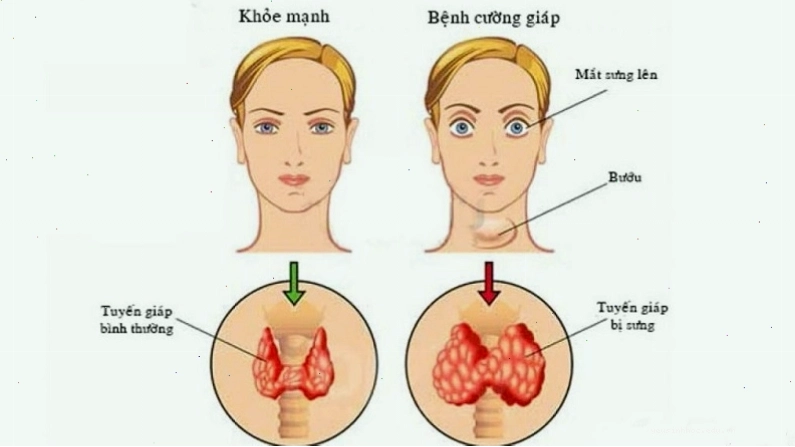 Bệnh cường giáp là nguyên nhân tại sao ăn mãi không béo, khiến người bệnh sụt cân nhanh chóng