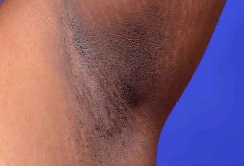 Bệnh gai đen xuất hiện ở vùng nách của người béo phì