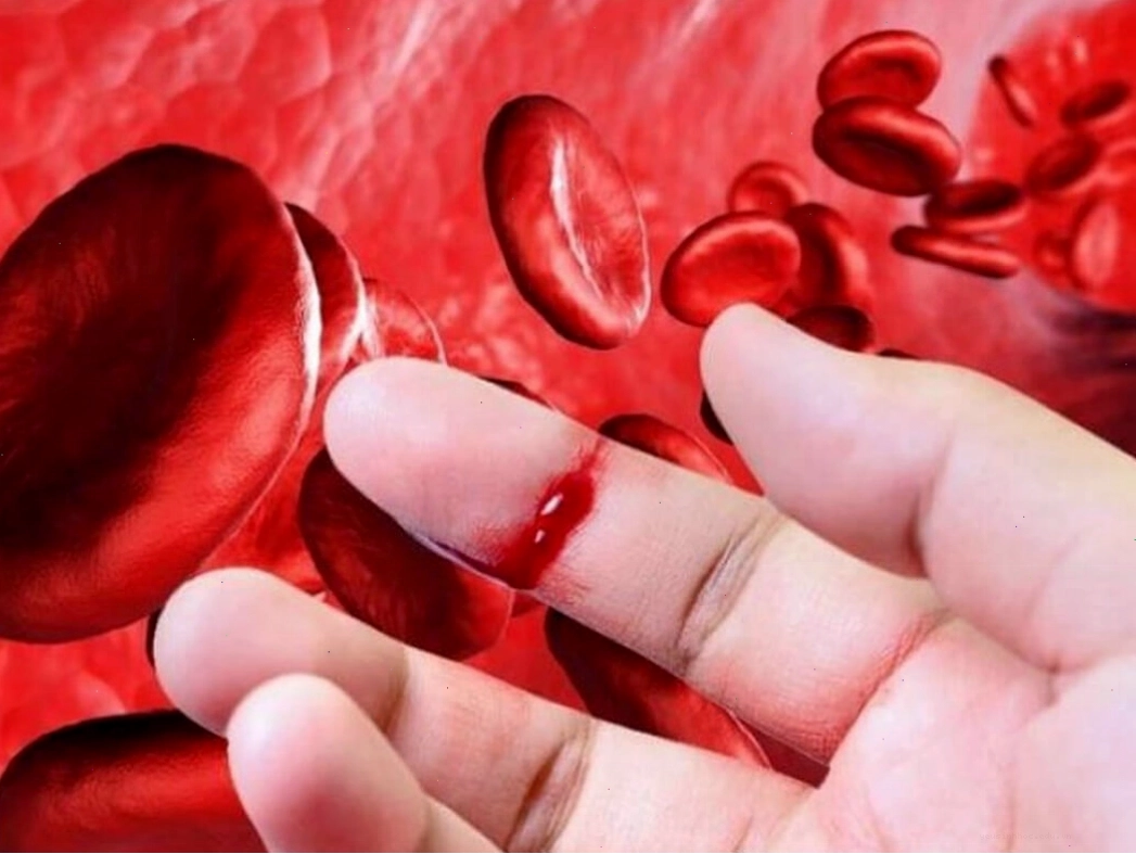 Bệnh máu khó đông là một rối loạn di truyền ảnh hưởng đến quá trình đông máu