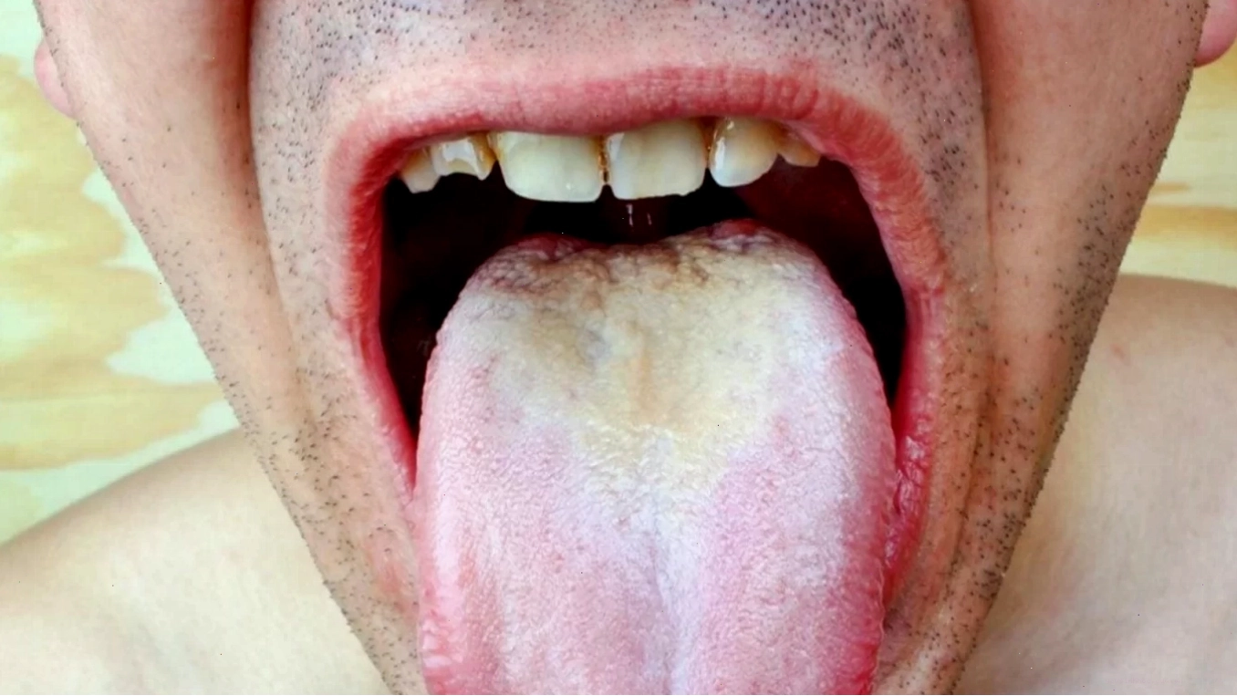 Bệnh nấm lưỡi do nấm Candida gây ra với các mảng trắng đặc trưng