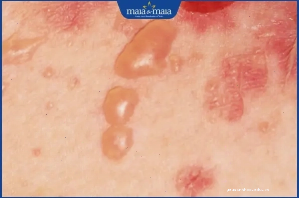 Bệnh Pemphigus gây mụn nước