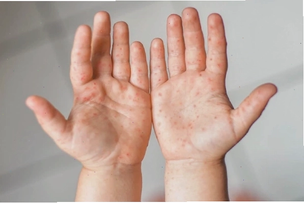 Bệnh tay chân miệng gây mọc mụn nước ở trẻ em