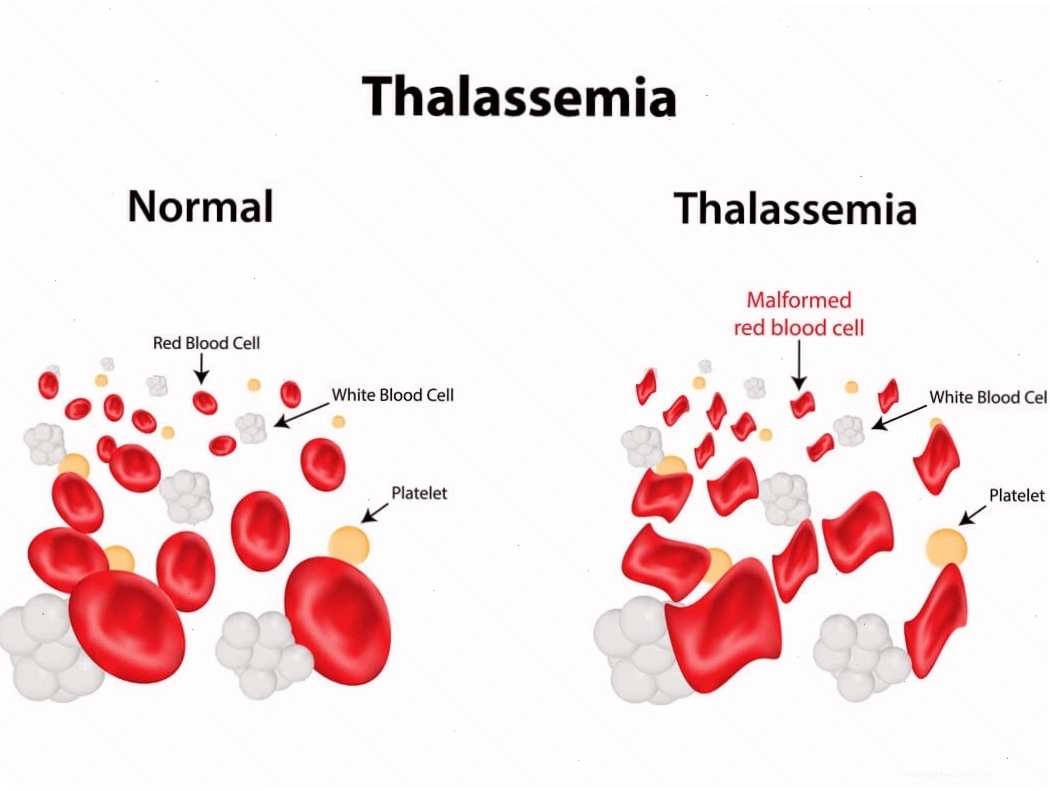 Bệnh Thalassemia là một bệnh di truyền máu phổ biến
