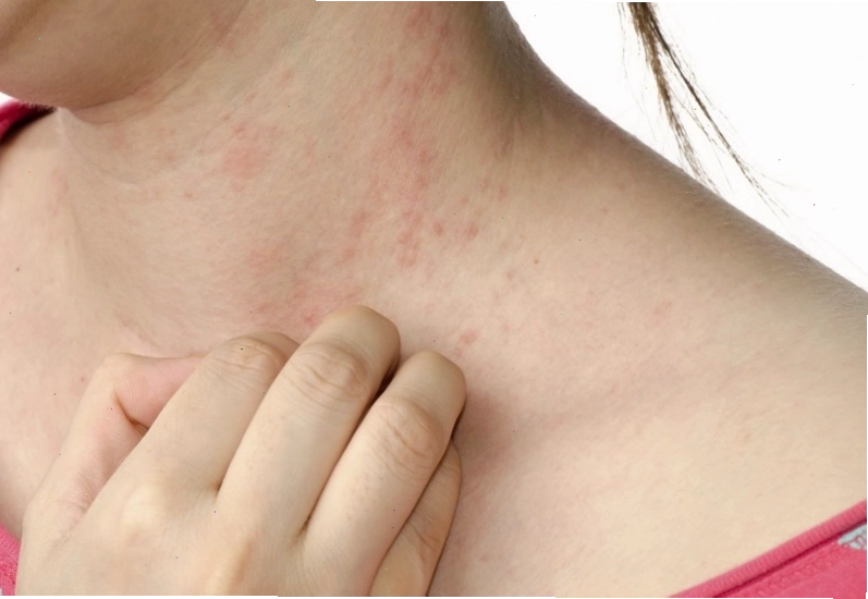 Bị ngứa khắp người có thể do thay đổi thời tiết